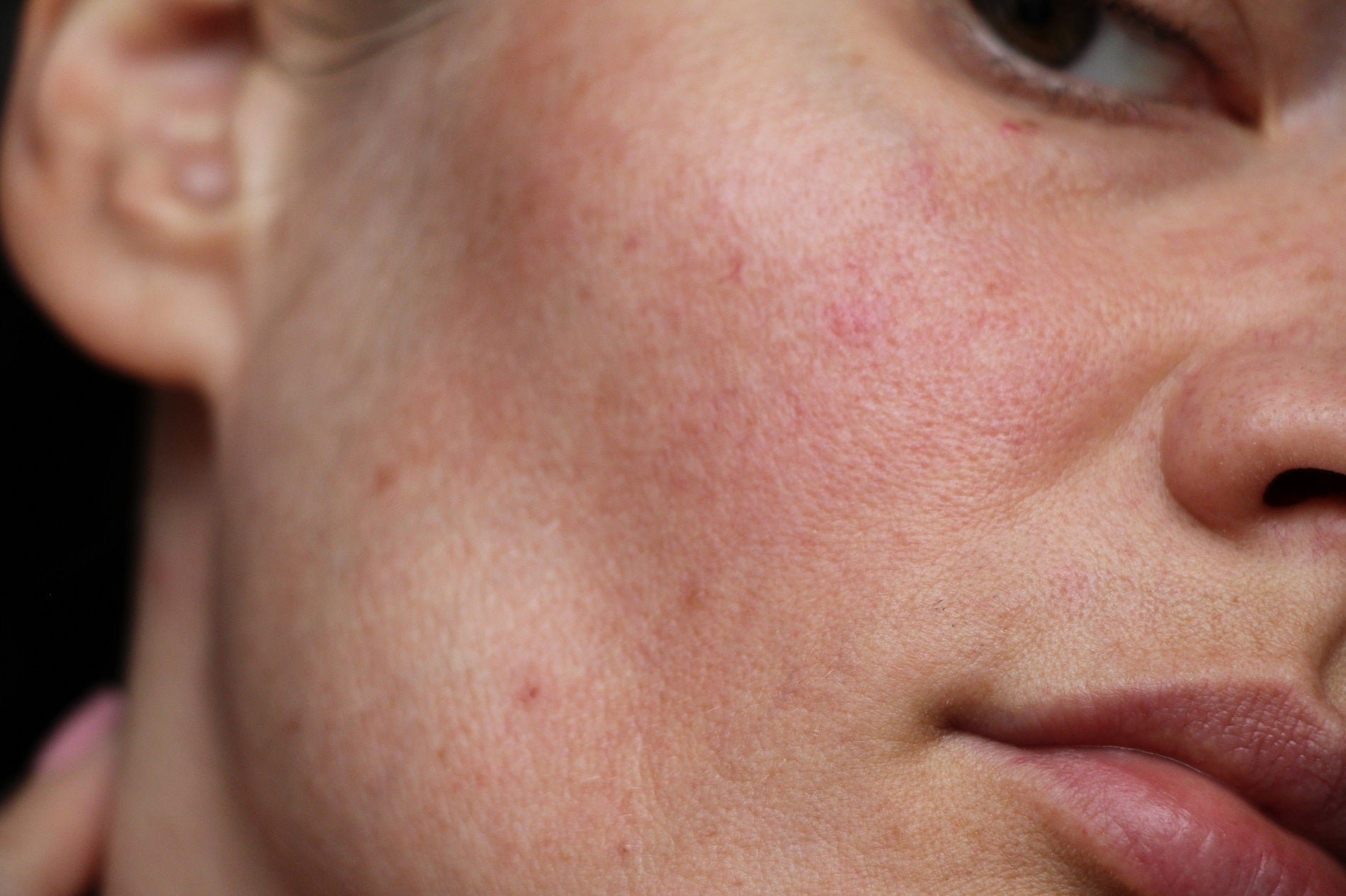 how-to-reduce-skin-inflammation-redness-oneskin