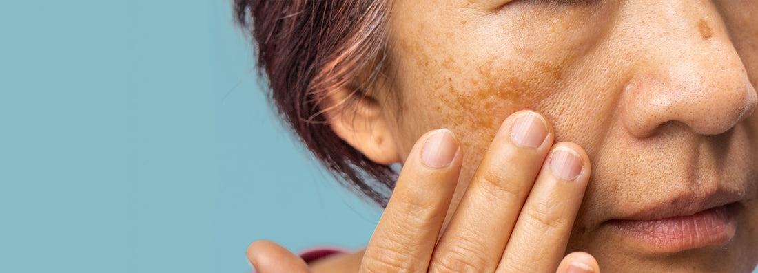 5 Common Perimenopause Skin Problems