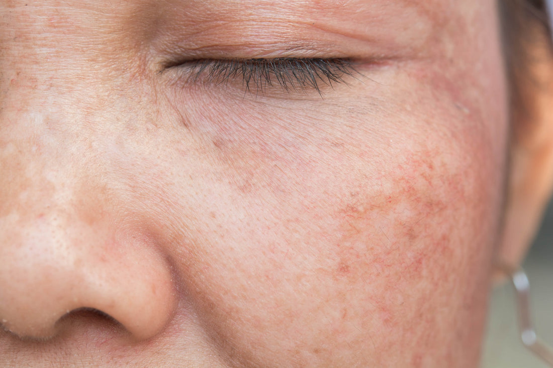 How To Get Rid of Crepey Skin: 7 Solutions