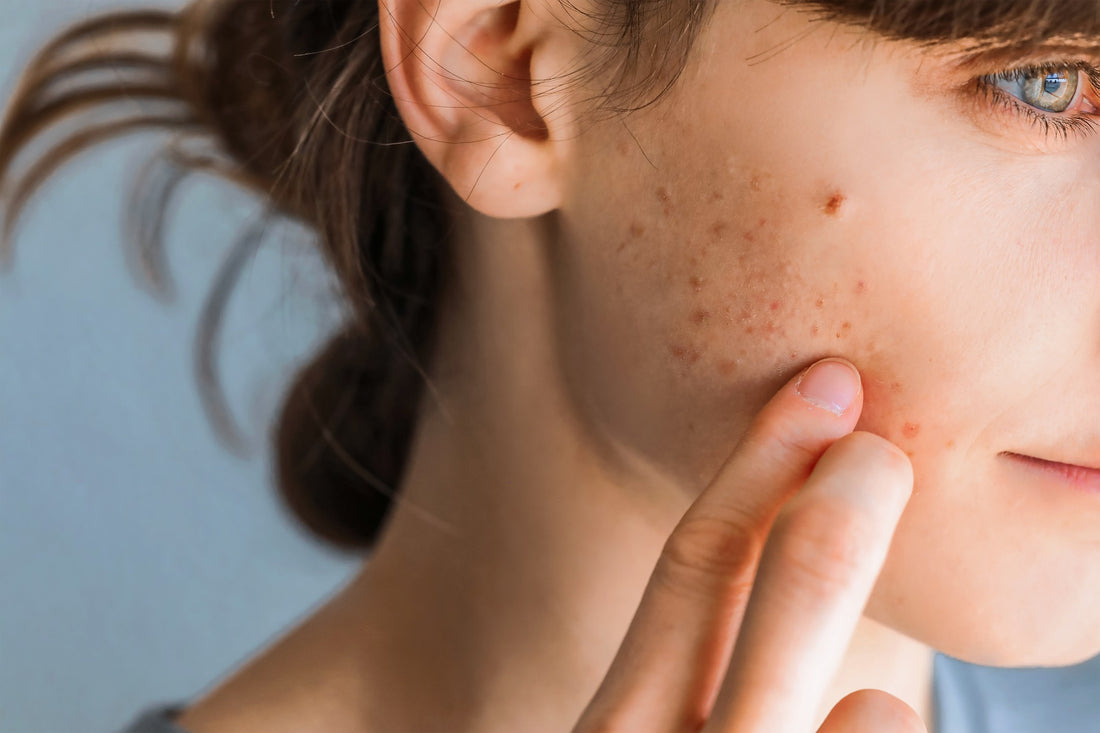 How To Heal Skin From Picking Your Face Too Much