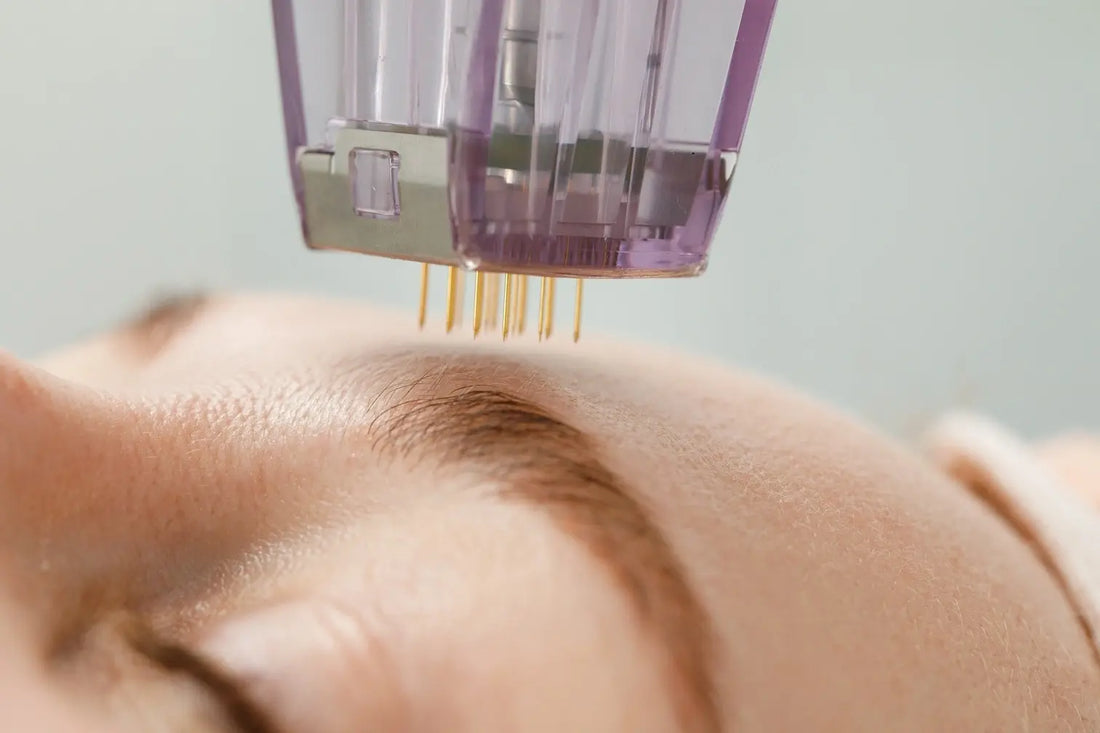 What is Microneedling & Are There Alternatives?