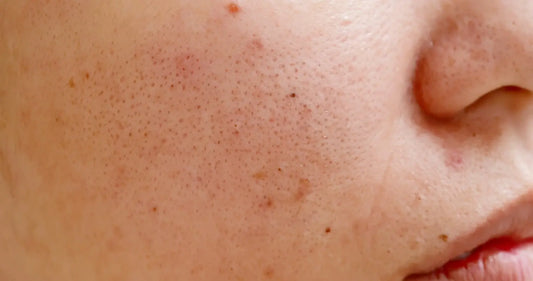 The 101 Guide To Understanding Acne-Prone Skin